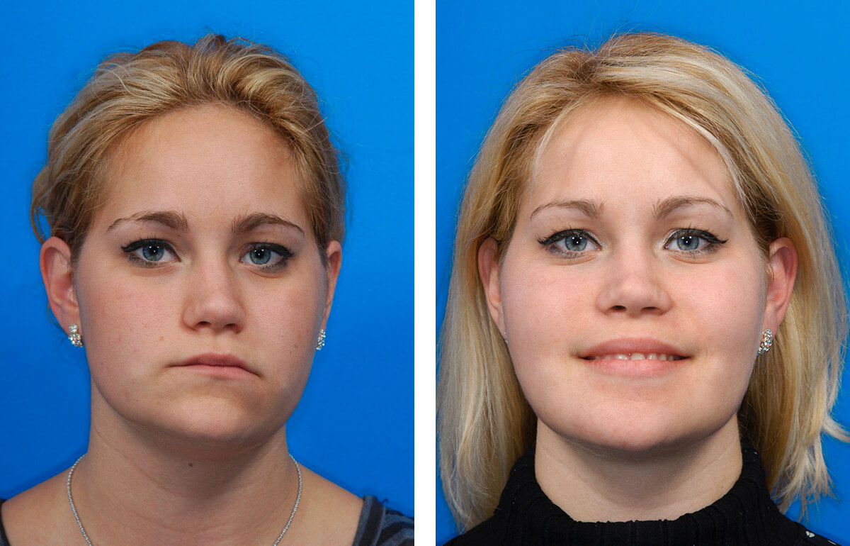 facial asymmetry - facial growth disorder